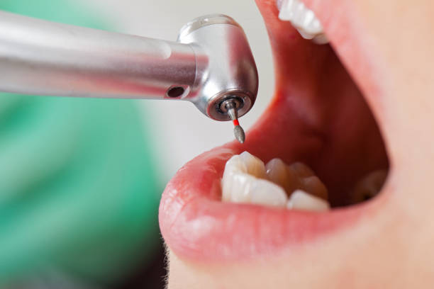 Best Emergency Tooth Extraction in Colona, IL